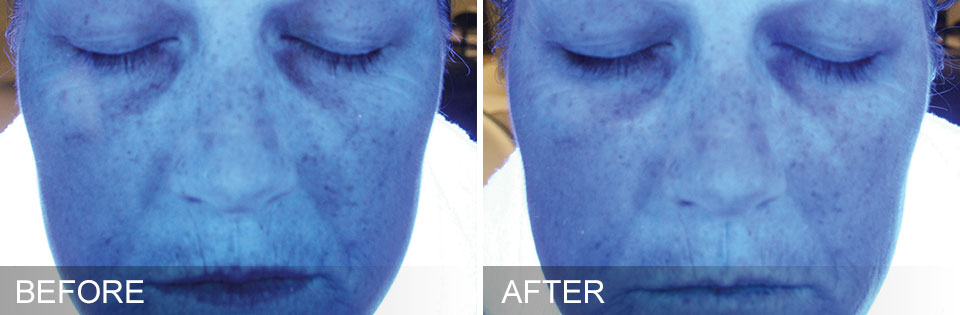 HydraFacial - Before & After for Hydration